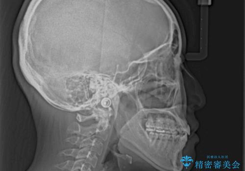 前歯のクロスバイトを治したい インビザラインによる矯正治療の治療後