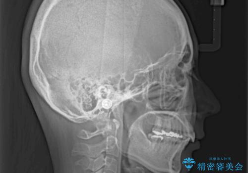 閉じにくい口元 前歯を引っ込める抜歯矯正の治療後