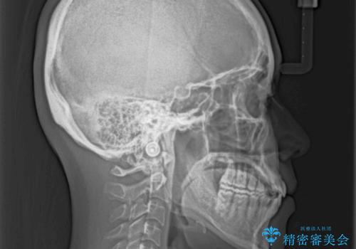 オープンバイトでかみにくい インビザラインによる矯正治療の治療後