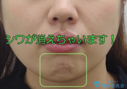 えっ シワが矯正で消えちゃう・・・? ボトックスから卒業しよう