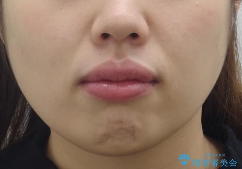 えっ シワが矯正で消えちゃう・・・? ボトックスから卒業しようの症例 治療前