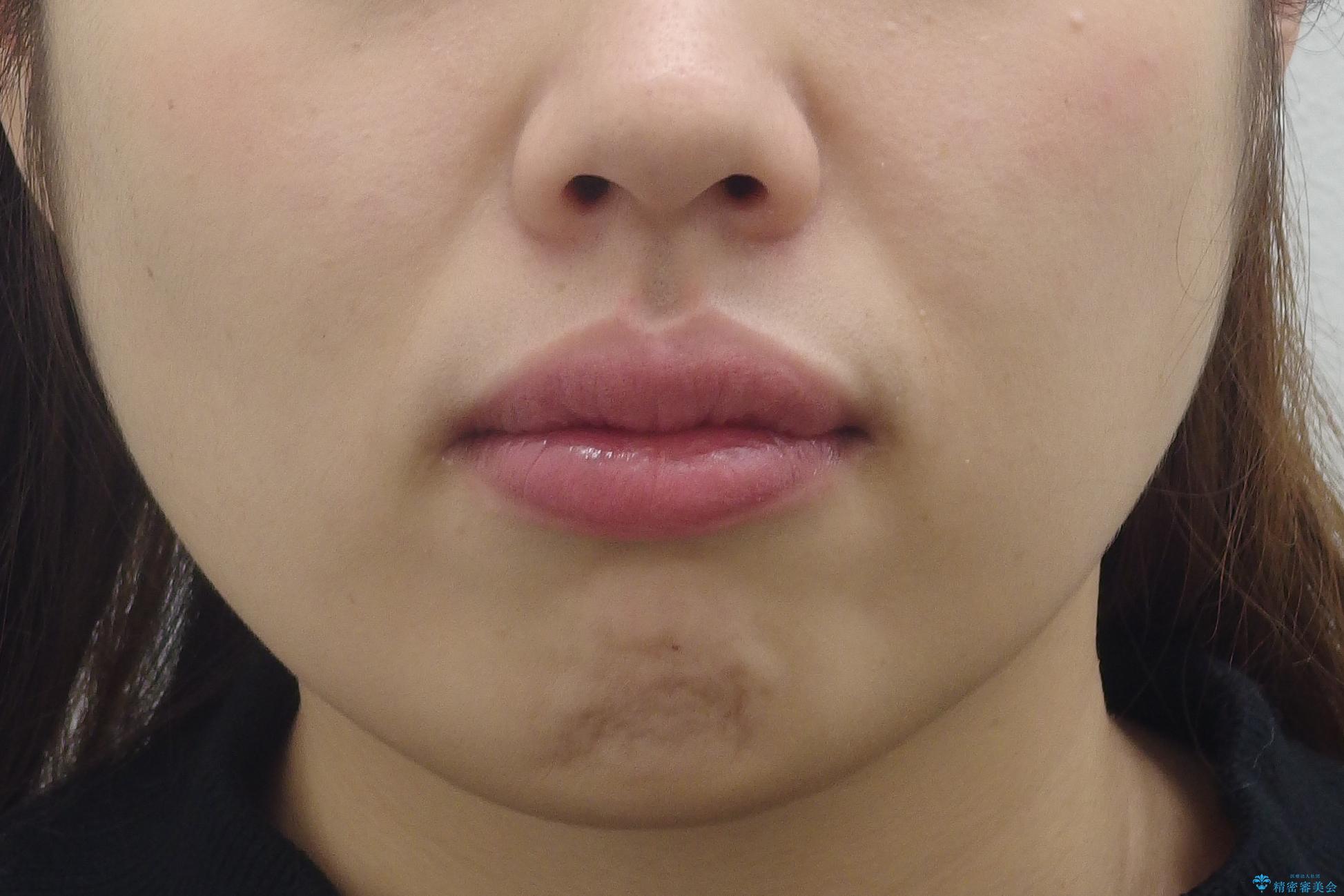 えっ シワが矯正で消えちゃう・・・? ボトックスから卒業しようの治療前(顔貌)