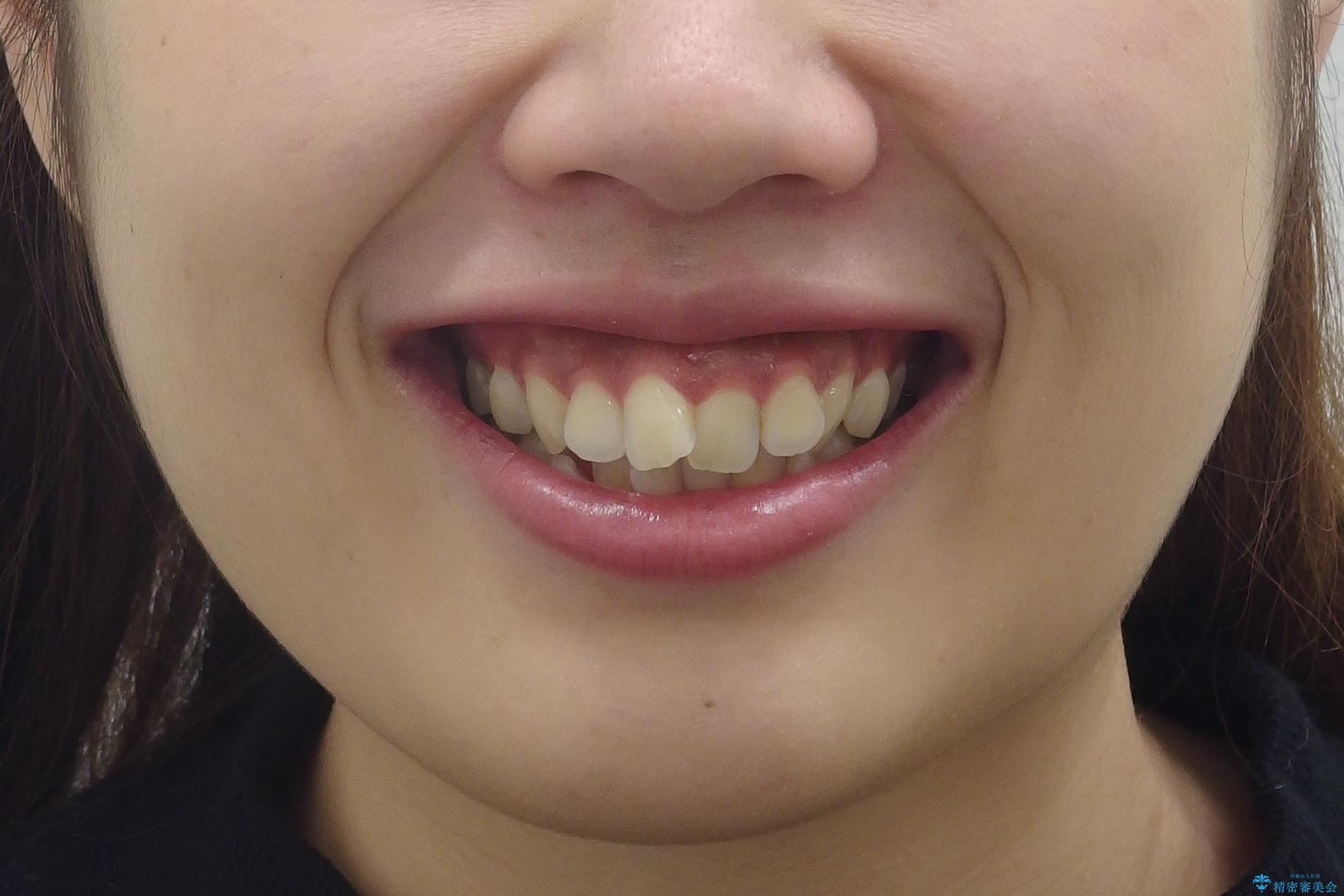 えっ シワが矯正で消えちゃう・・・? ボトックスから卒業しようの治療前(顔貌)