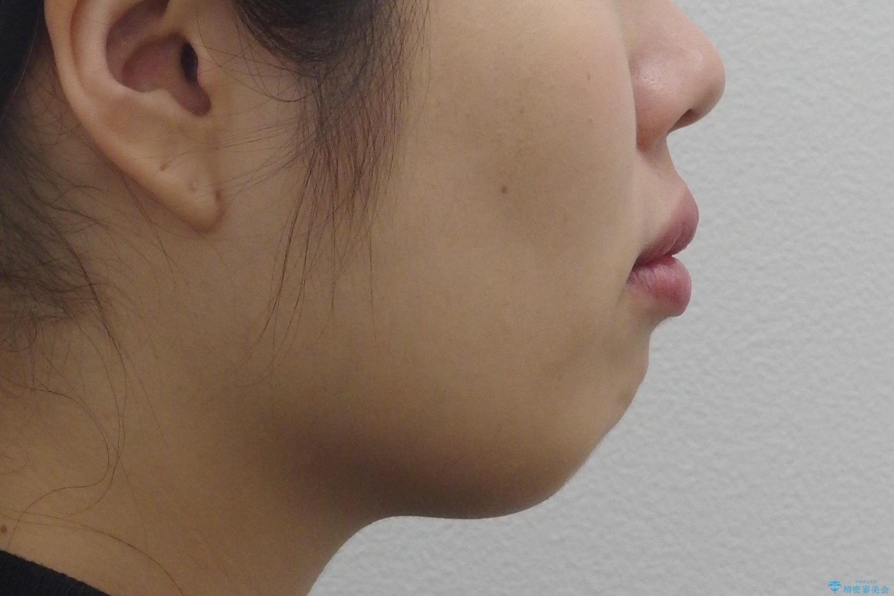 えっ シワが矯正で消えちゃう・・・? ボトックスから卒業しようの治療前(顔貌)