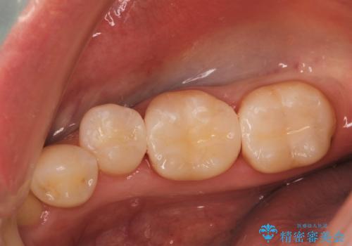 歯と歯の間に食べ物がつまる、金属を白くしたい、セラミックインレーにて修復
