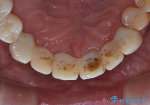 治療中にPMTCでメンテナンスの症例 治療前