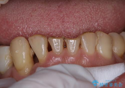 治療中にPMTCでメンテナンスの治療前