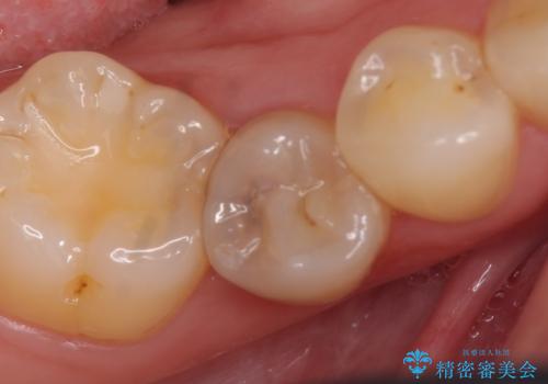 オールセラミッククラウン ズキズキ痛む虫歯の治療の症例 治療前