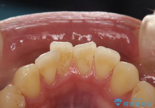 PMTCで歯をキレイにの症例 治療前