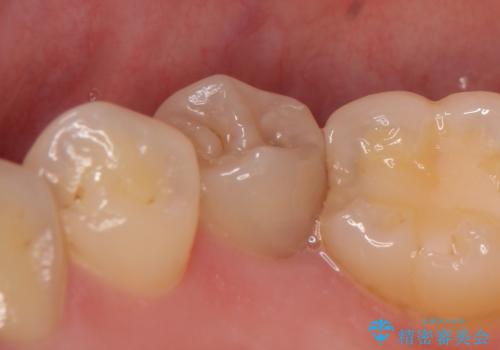 オールセラミッククラウン ズキズキ痛む虫歯の治療の治療前