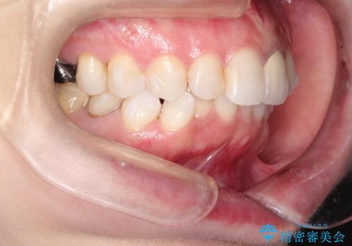 インビザラインによる非抜歯矯正 ガタガタな歯並びを整った歯並びへの治療中