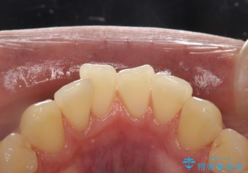 PMTCで歯をキレイにの症例 治療後