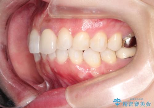 インビザラインによる非抜歯矯正　ガタガタな歯並びを整った歯並びへの治療中