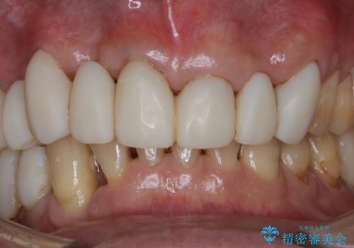 治療中にPMTCでメンテナンスの治療後