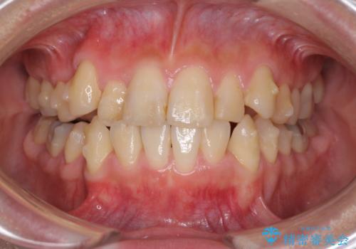 上下の八重歯を治したい インビザラインと補助装置を用いた抜歯治療の治療中