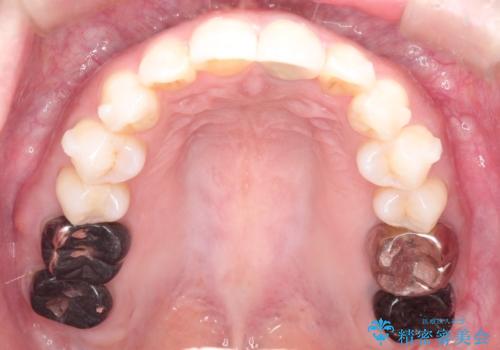 インビザラインによる非抜歯矯正 ガタガタな歯並びを整った歯並びへの治療中