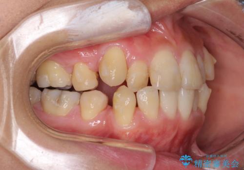 上下の八重歯を治したい インビザラインと補助装置を用いた抜歯治療の治療中