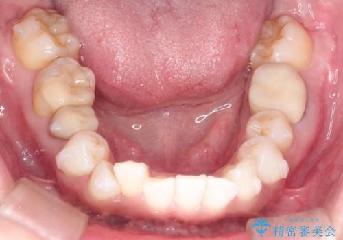 インビザラインによる非抜歯矯正　ガタガタな歯並びを整った歯並びへの治療中