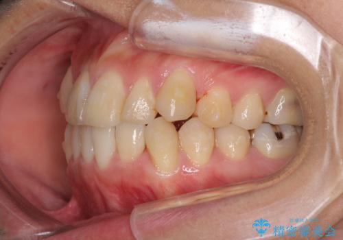 上下の八重歯を治したい　インビザラインと補助装置を用いた抜歯治療の治療中