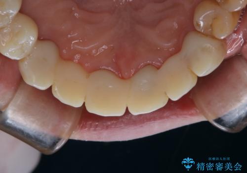 治療中にPMTCでメンテナンスの症例 治療後