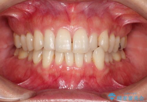 八重歯のインビザライン矯正治療の治療前