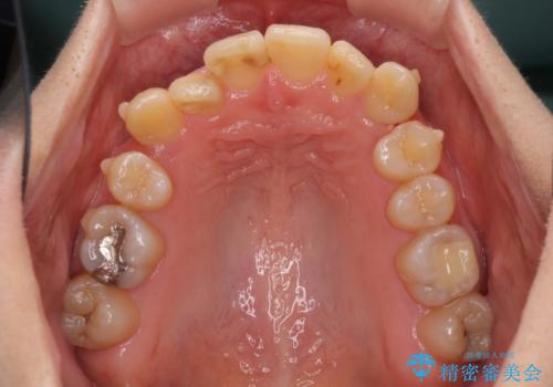 上下の八重歯を治したい インビザラインと補助装置を用いた抜歯治療の治療中