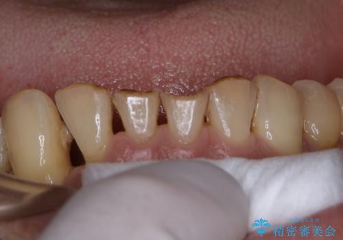 治療中にPMTCでメンテナンスの治療後