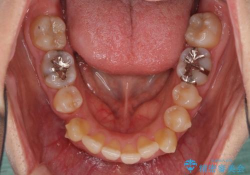 上下の八重歯を治したい インビザラインと補助装置を用いた抜歯治療の治療中