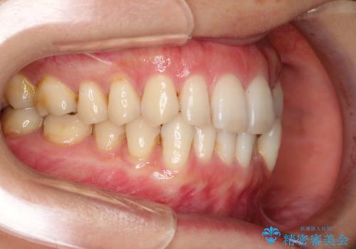 八重歯のインビザライン矯正治療の治療前