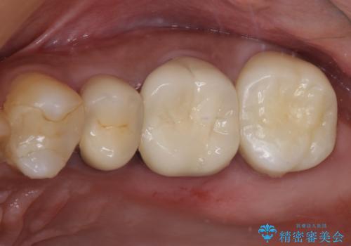 食事で痛む 神経を極力残した虫歯治療の症例 治療後
