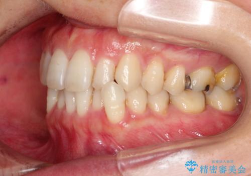 八重歯のインビザライン矯正治療の治療前