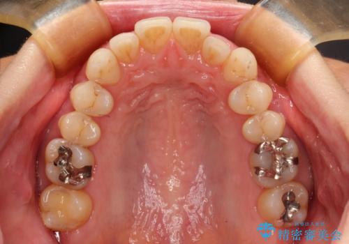八重歯のインビザライン矯正治療の治療前
