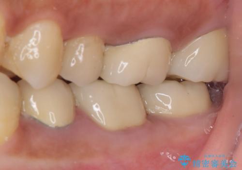 食事で痛む 神経を極力残した虫歯治療の治療後