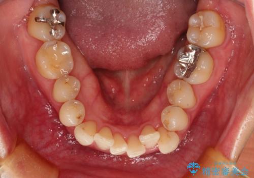 八重歯のインビザライン矯正治療の治療前