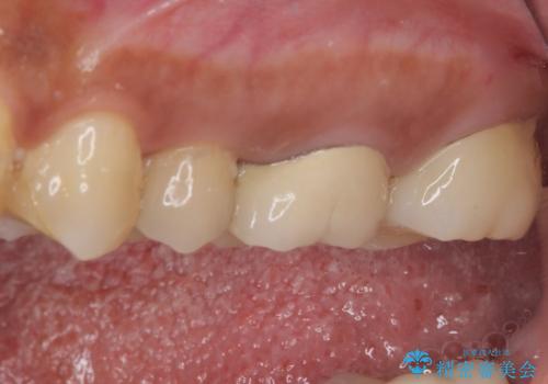 食事で痛む 神経を極力残した虫歯治療の治療後