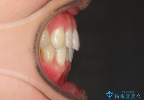 八重歯のインビザライン矯正治療の治療前