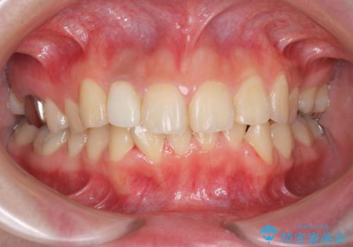 オフィスホワイトニングで歯の色を白くして清潔感アップ!!の症例 治療前