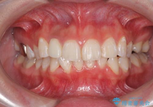 オフィスホワイトニングで歯の色を白くして清潔感アップ!!