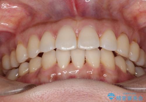 前歯のがたつきと隙間の矯正 インビザラインにての治療後