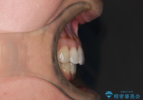 前歯のがたつきと隙間の矯正 インビザラインにての治療後