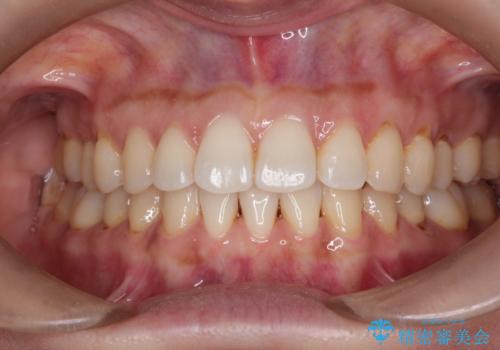 前歯のがたつきと隙間の矯正 インビザラインにての症例 治療後