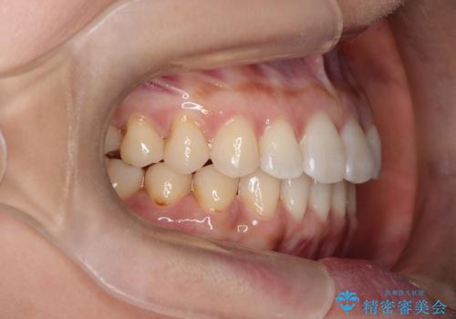 前歯のがたつきと隙間の矯正 インビザラインにての治療後