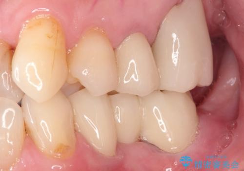 金属のかぶせ物をセラミックへ 根管治療からの再治療の治療後