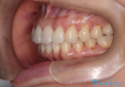 前歯のがたつきと隙間の矯正　インビザラインにての治療後