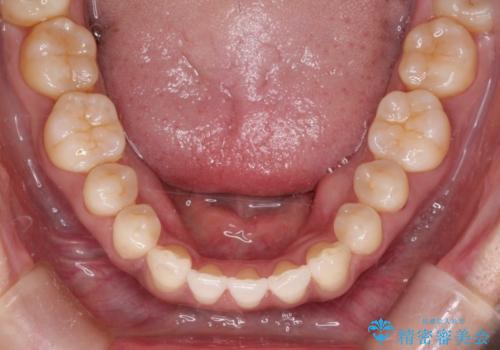 前歯のがたつきと隙間の矯正　インビザラインにての治療後