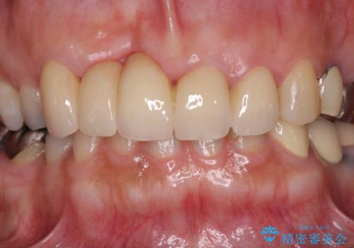 汚い仮歯で困っている 前歯のオールセラミックブリッジの治療後
