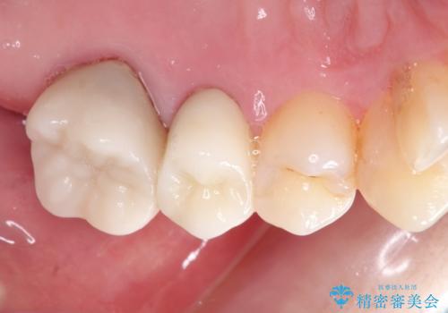 金属のかぶせ物をセラミックへ 根管治療からの再治療の治療後