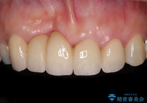 汚い仮歯で困っている 前歯のオールセラミックブリッジの症例 治療後