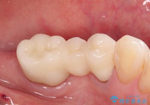 金属のかぶせ物をセラミックへ 根管治療からの再治療の治療後