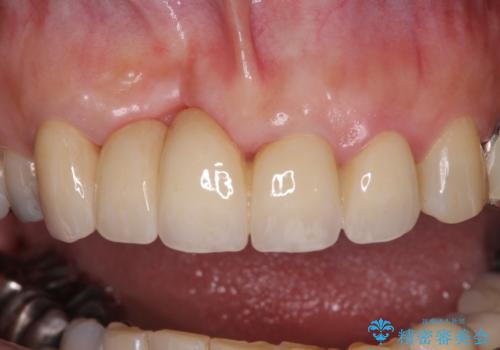 汚い仮歯で困っている 前歯のオールセラミックブリッジの治療後